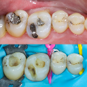 Minimally Invasive Dentistry Equipment